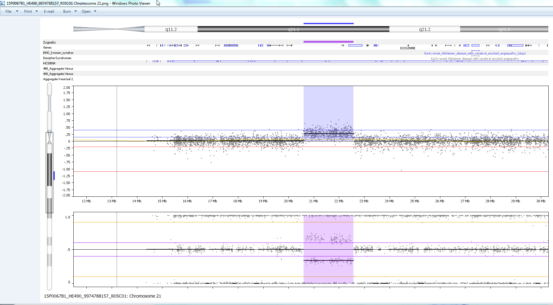 Array op buffy coat: 2 Mb mat duplicatie chr21:20,604,811-22,572,304: klinische