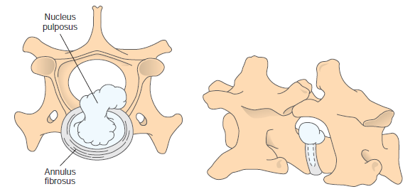Fig. 1: Hansen type I discus hernia. (Fossum 2013) Bij een Hansen type II discus hernia is de annulus fibrosus aangetast.