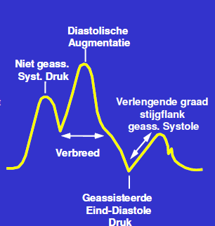 Te vroege deflatie Als de ballon te vroeg leegloopt, heeft de aorta tijd om zich weer te vullen met bloed voordat het linkerventrikel zijn bloed uitpompt.