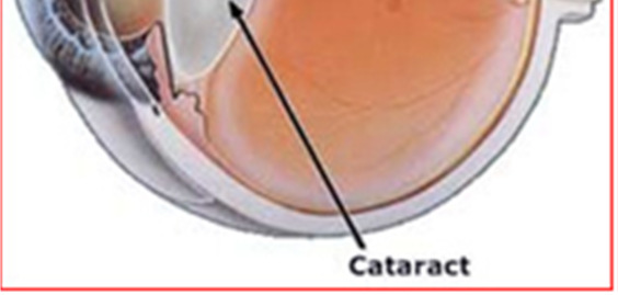 Cataract De ooglens, die zich achter de pupil bevindt, is normaal gesproken helder. Wanneer deze lens troebel wordt spreekt men van staar. De medische term voor staar is cataract.