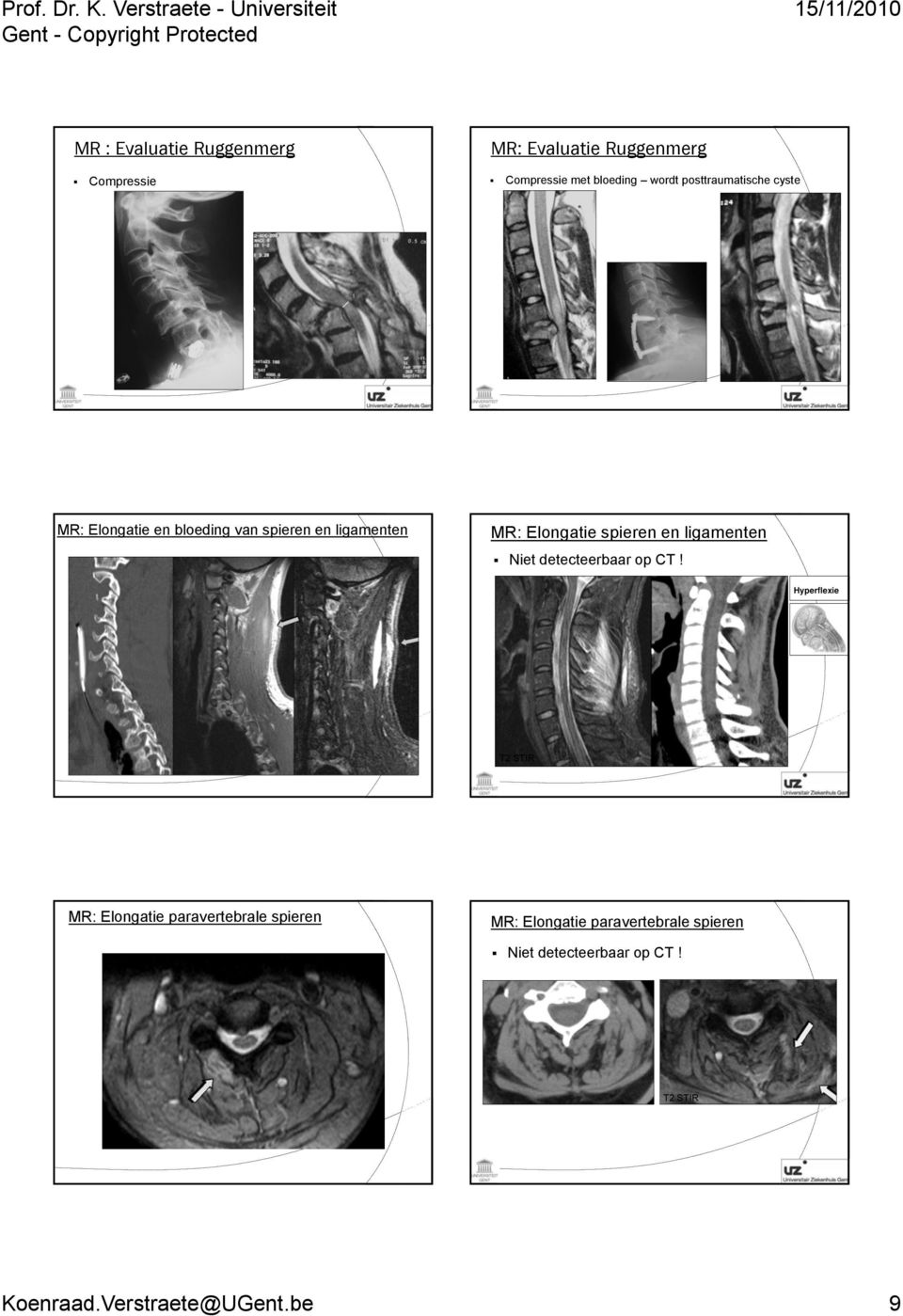 en ligamenten Niet detecteerbaar op CT!