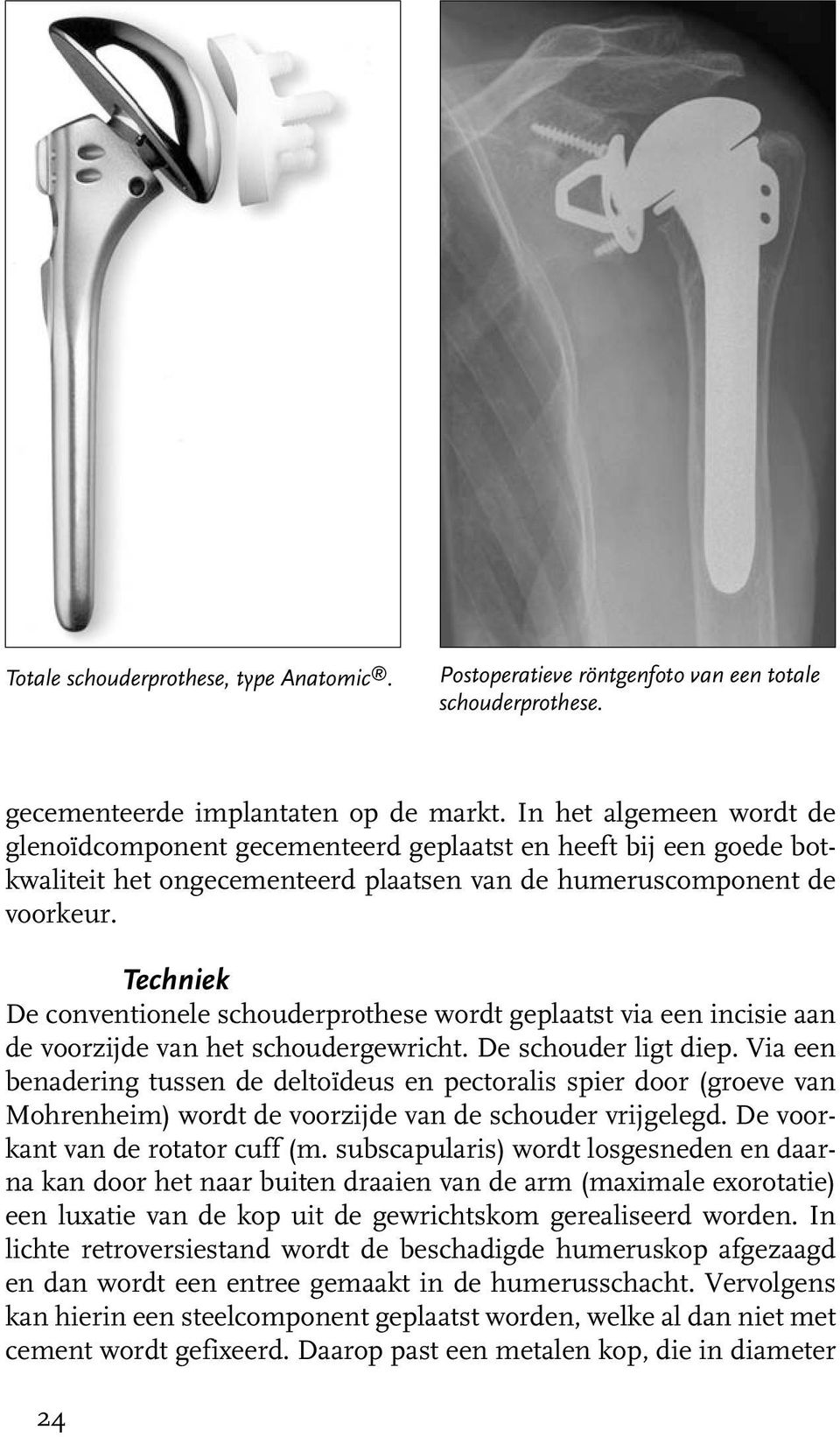 Techniek De conventionele schouderprothese wordt geplaatst via een incisie aan de voorzijde van het schoudergewricht. De schouder ligt diep.