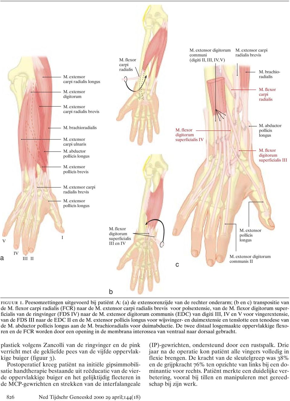 Peesomzettingen uitgevoerd bij patiënt A: (a) de extensorenzijde van de rechter onderarm; (b en c) transpositie van de carpi radialis (FCR) naar de carpi radialis brevis voor polsextensie, van de