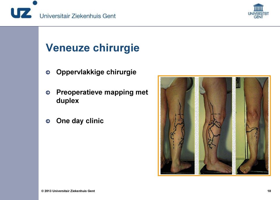 Preoperatieve mapping