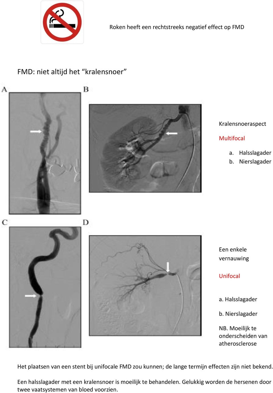 Moeilijk te onderscheiden van atherosclerose Het plaatsen van een stent bij unifocale FMD zou kunnen; de lange termijn