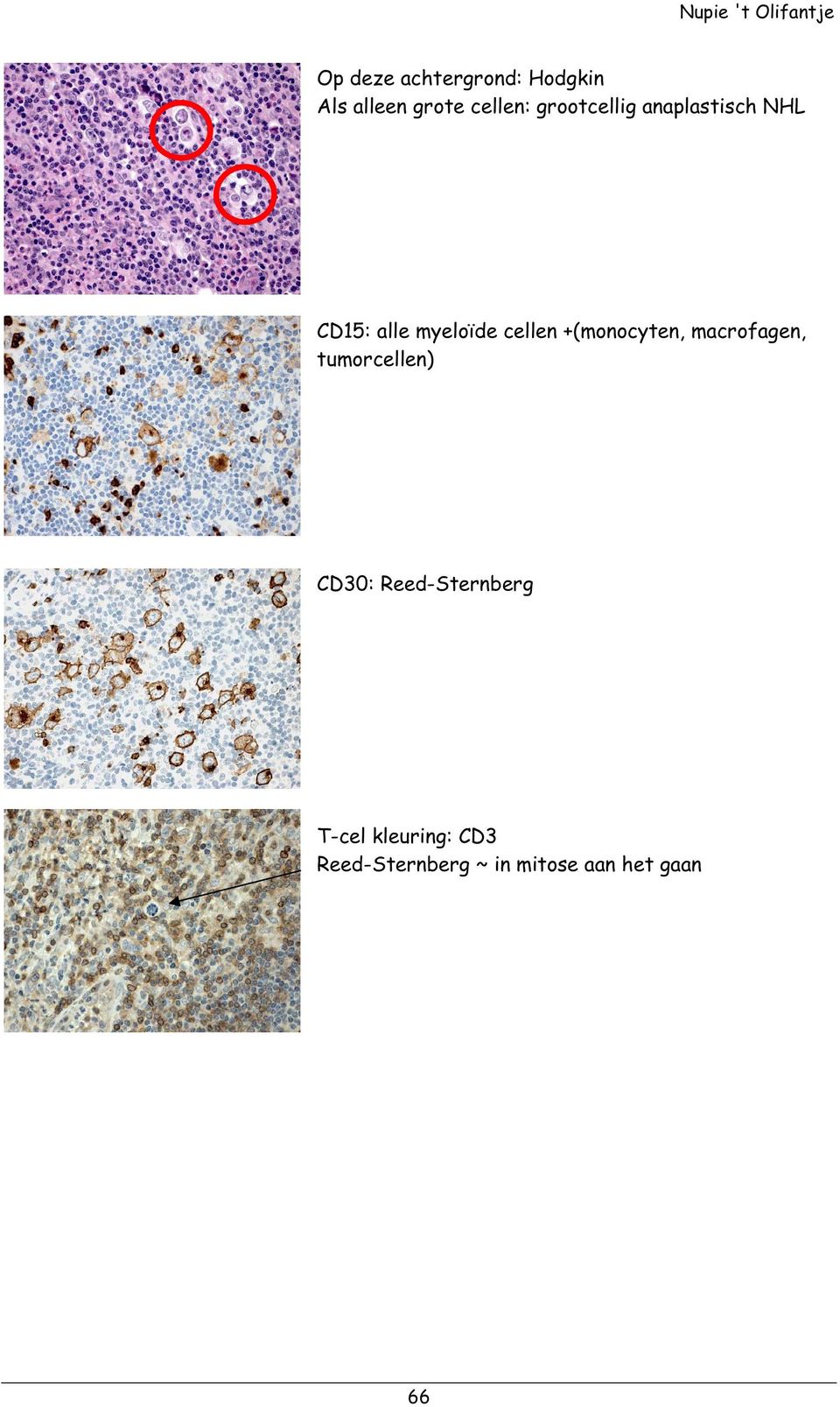 +(monocyten, macrofagen, tumorcellen) CD30: