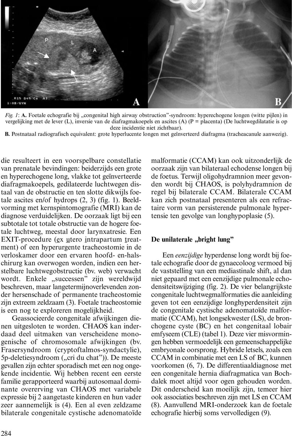 placenta) (De luchtwegdilatatie is op deze incidentie niet zichtbaar). B. Postnataal radiografisch equivalent: grote hyperlucente longen met geïnverteerd diafragma (tracheacanule aanwezig).