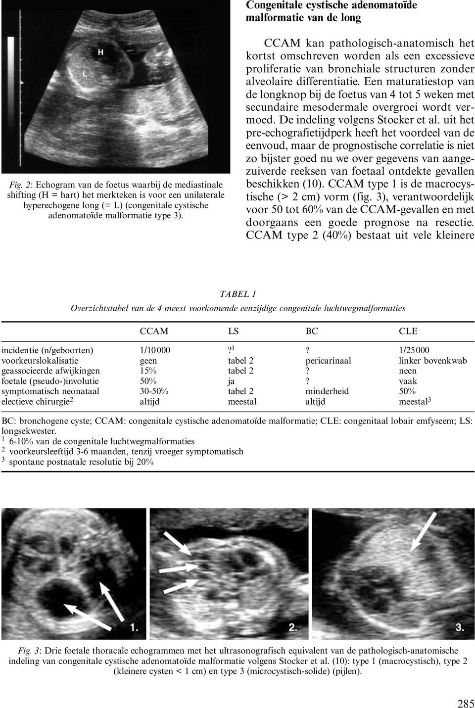 CCAM kan pathologisch-anatomisch het kortst omschreven worden als een excessieve proliferatie van bronchiale structuren zonder alveolaire differentiatie.