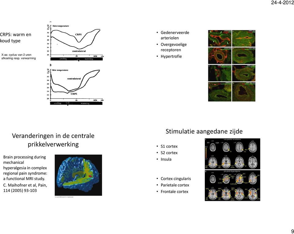 prikkelverwerking Brain processing during mechanical hyperalgesia in complex regional pain syndrome: a