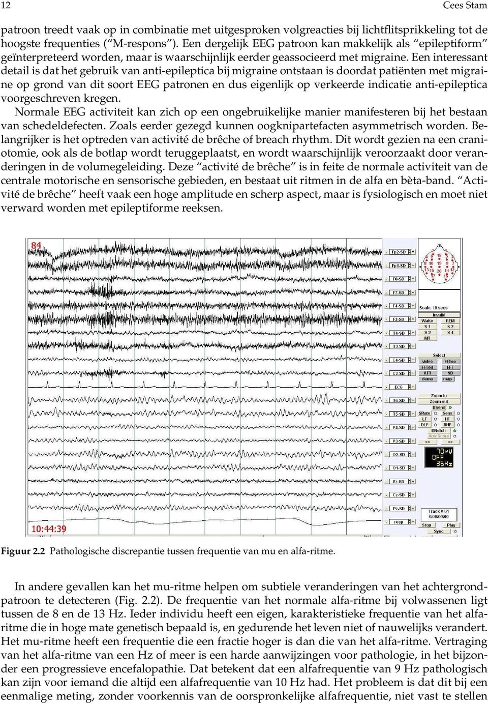 Een interessant detail is dat het gebruik van anti-epileptica bij migraine ontstaan is doordat patiënten met migraine op grond van dit soort EEG patronen en dus eigenlijk op verkeerde indicatie