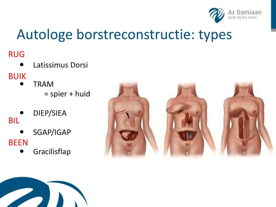 Latissimus Dorsi TRAM = spier