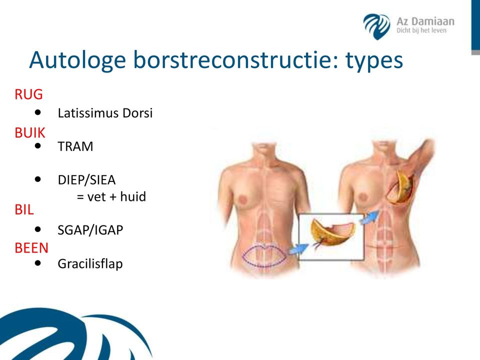 Latissimus Dorsi TRAM