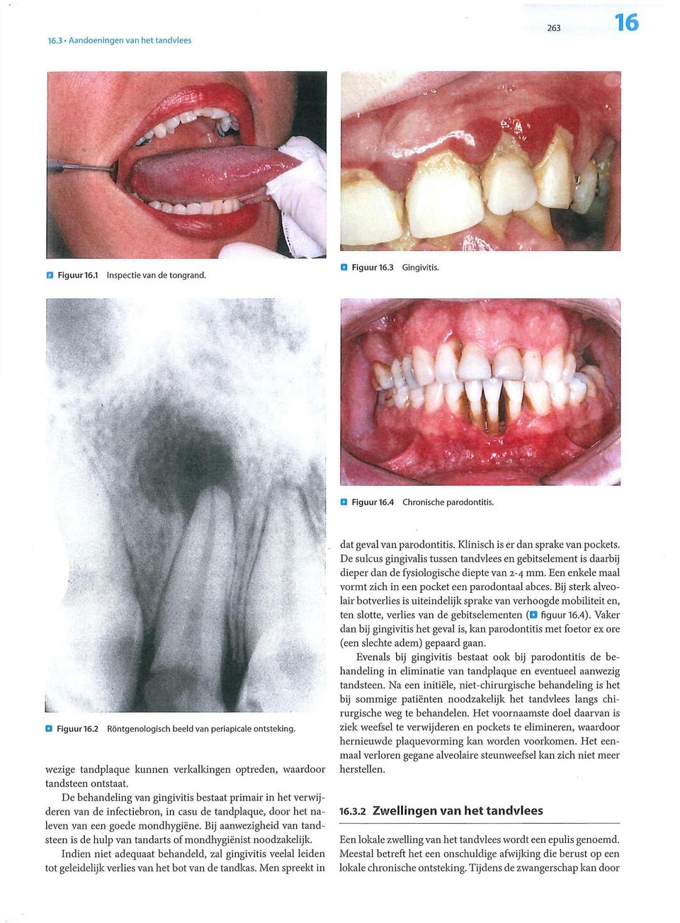 De behandeling van gingivitis bestaat primair in het verwijderen van de infectiebron, in casu de tandplaque, door het naleven van een goede mondhygiëne.