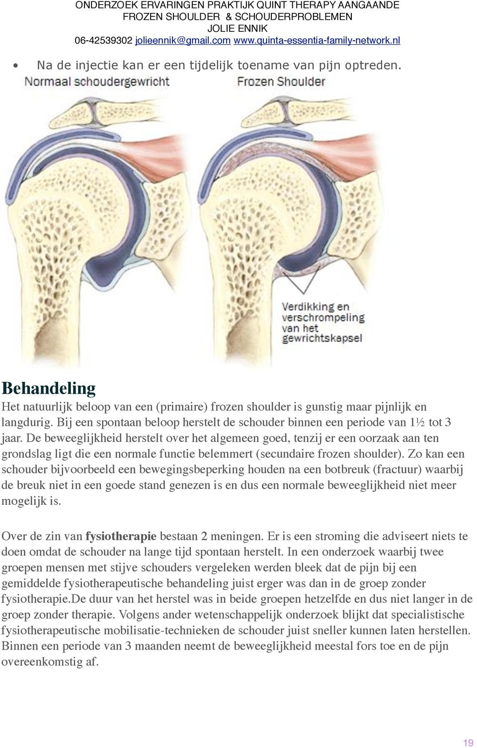 De beweeglijkheid herstelt over het algemeen goed, tenzij er een oorzaak aan ten grondslag ligt die een normale functie belemmert (secundaire frozen shoulder).