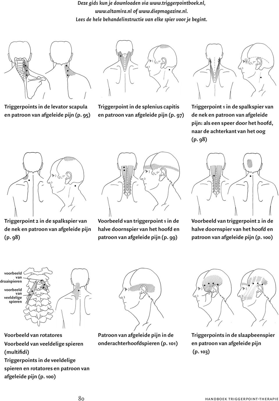 97) Triggerpoint 1 in de spalkspier van de nek en patroon van afgeleide pijn: als een speer door het hoofd, naar de achterkant van het oog (p.
