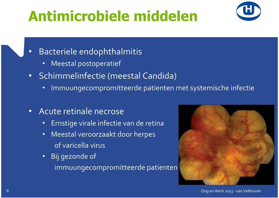 systemische infectie Acute retinale necrose Ernstige virale infectie van de retina