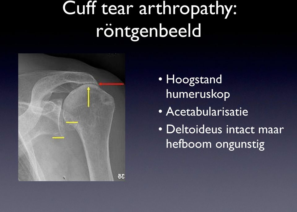 humeruskop Acetabularisatie