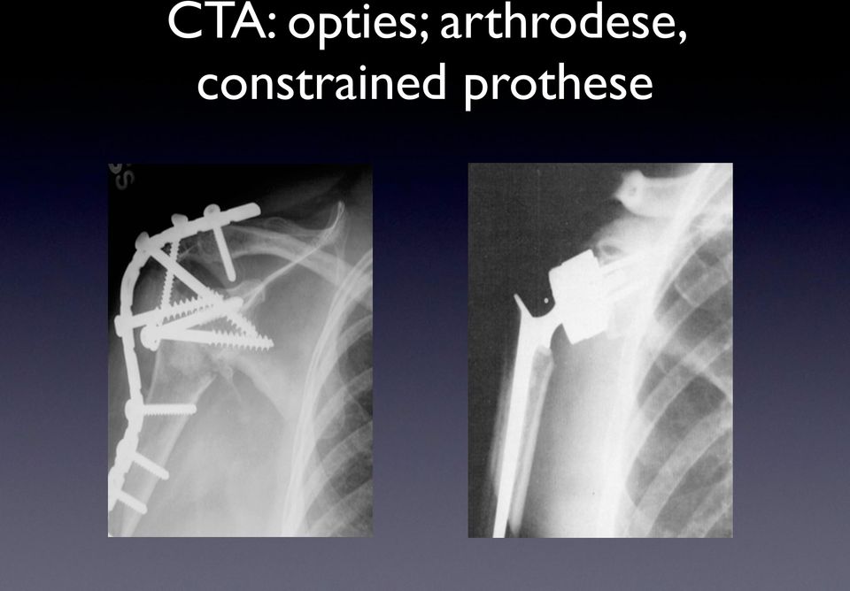 arthrodese,