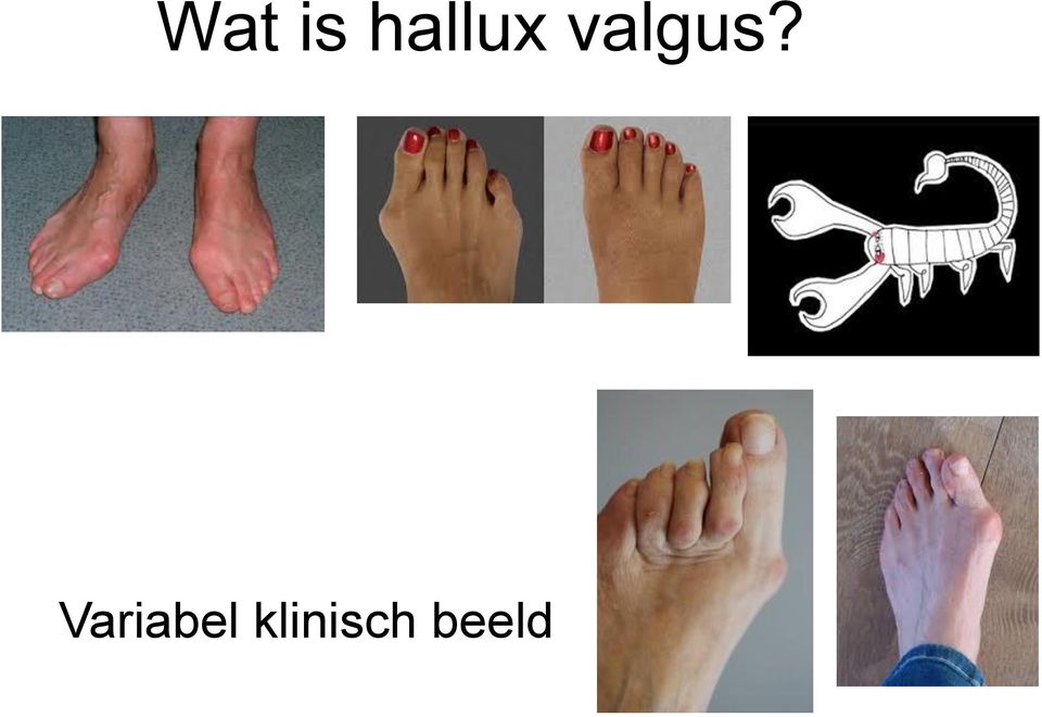 valgus?