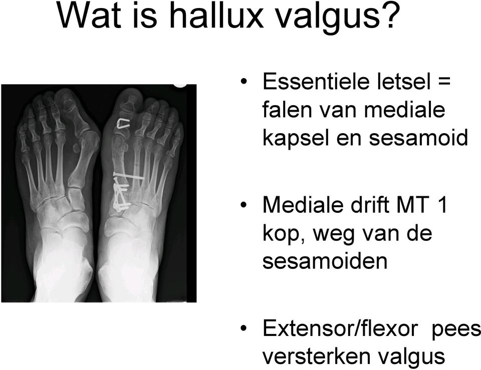 kapsel en sesamoid Mediale drift MT 1