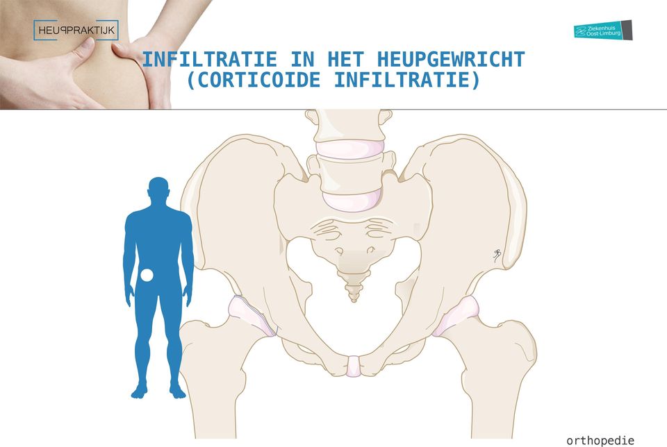 (CORTICOIDE