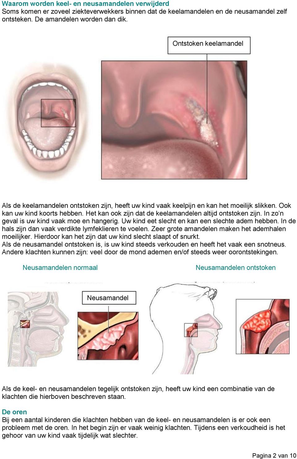 Het kan ook zijn dat de keelamandelen altijd ontstoken zijn. In zo n geval is uw kind vaak moe en hangerig. Uw kind eet slecht en kan een slechte adem hebben.