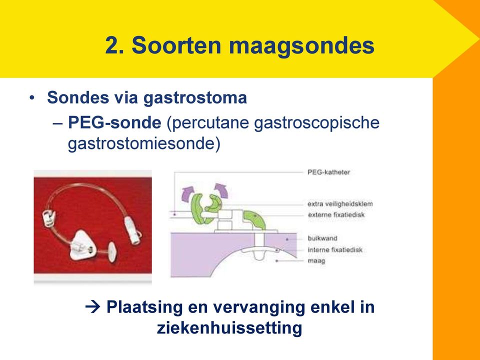 gastroscopische gastrostomiesonde)