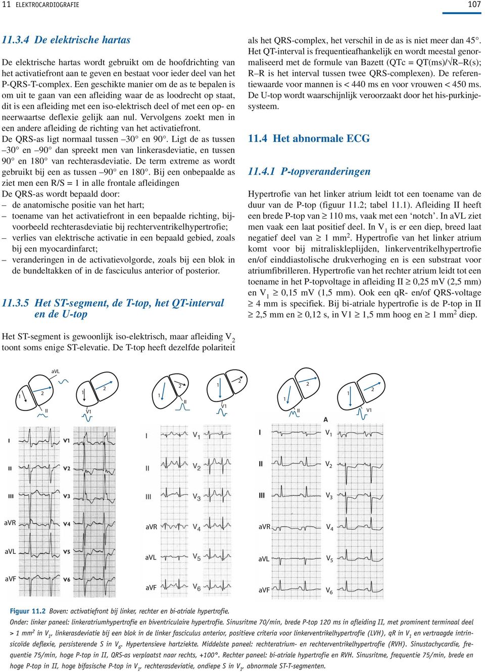 aan nul Vervolgens zoekt men in een andere afleiding de richting van het activatiefront De QRS-as ligt normaal tussen 0 en 90 Ligt de as tussen 0 en 90 dan spreekt men van linkerasdeviatie, en tussen