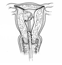 De rollerbolmethode Bij de rollerbolmethode brengt de gynaecoloog via de vagina een hysteroscoop (kijkbuis) in de baarmoeder, zodat de baarmoederholte zichtbaar wordt.