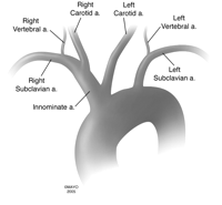 calcification carotid bifurcation Tortuosity of the carotid artery ( 2