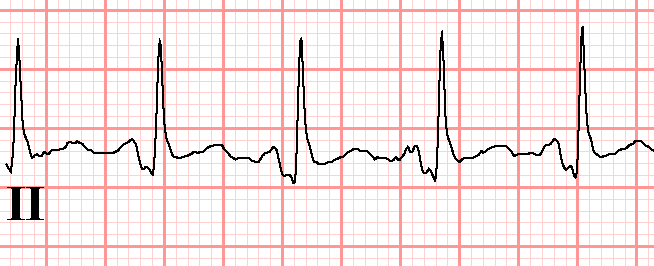 Pericarditis -Diffusie