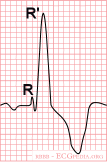 RBTB QRS > 0.