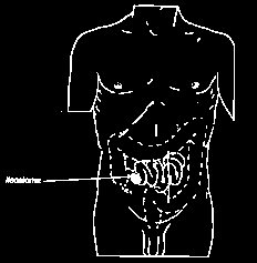 Ileostoma Een ileostoma is een kunstmatige uitgang van de dunne darm (het ileum). Een ileostoma is vaak nodig als de dikke darm (tijdelijk) buiten werking is gesteld of is weggenomen.