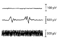 Hieronder gaan we bekijken welk effect dit heeft op het EMG dat de laborant bij een spierstoornis zal meten. Figuur 3.17 is een EMG van een persoon met een spierstoornis.