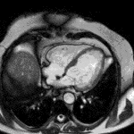 Cardiologie anno 2016 Ablatie van