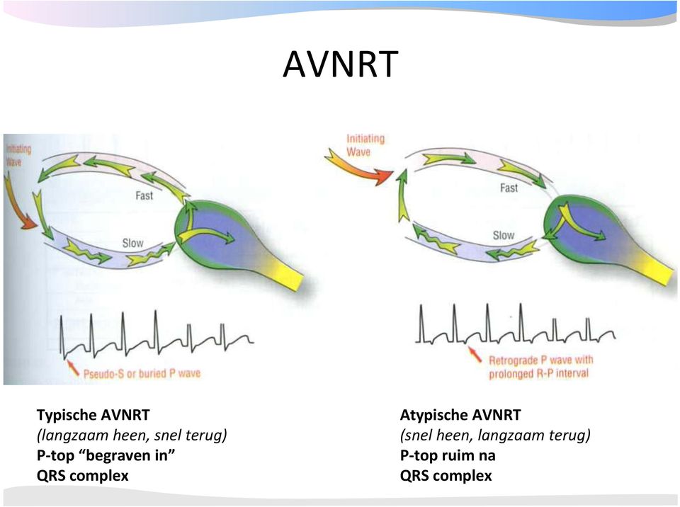 complex Atypische AVNRT (snel heen,