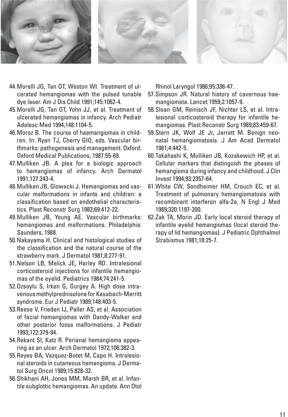 Vascular birthmarks: pathogenesis and management. Oxford: Oxford Medical Publications, 1987:55-69. 47. Mulliken JB. A plea for a biologic approach to hemangiomas of infancy.