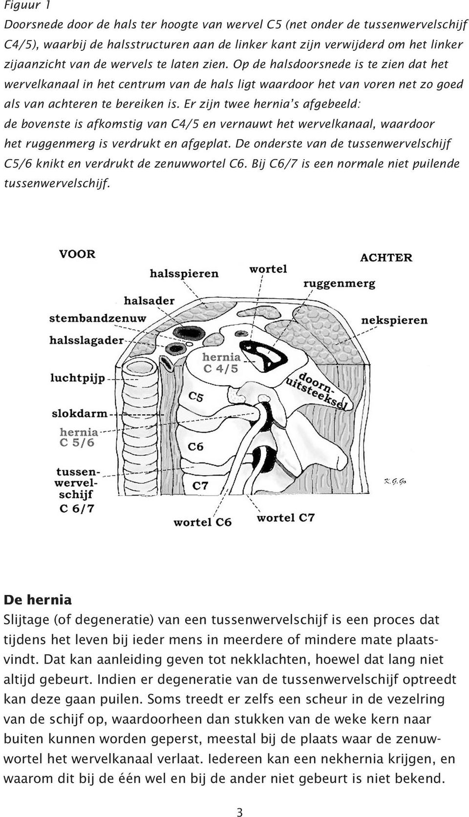 Er zijn twee hernia s afgebeeld: de bovenste is afkomstig van C4/5 en vernauwt het wervelkanaal, waardoor het ruggenmerg is verdrukt en afgeplat.
