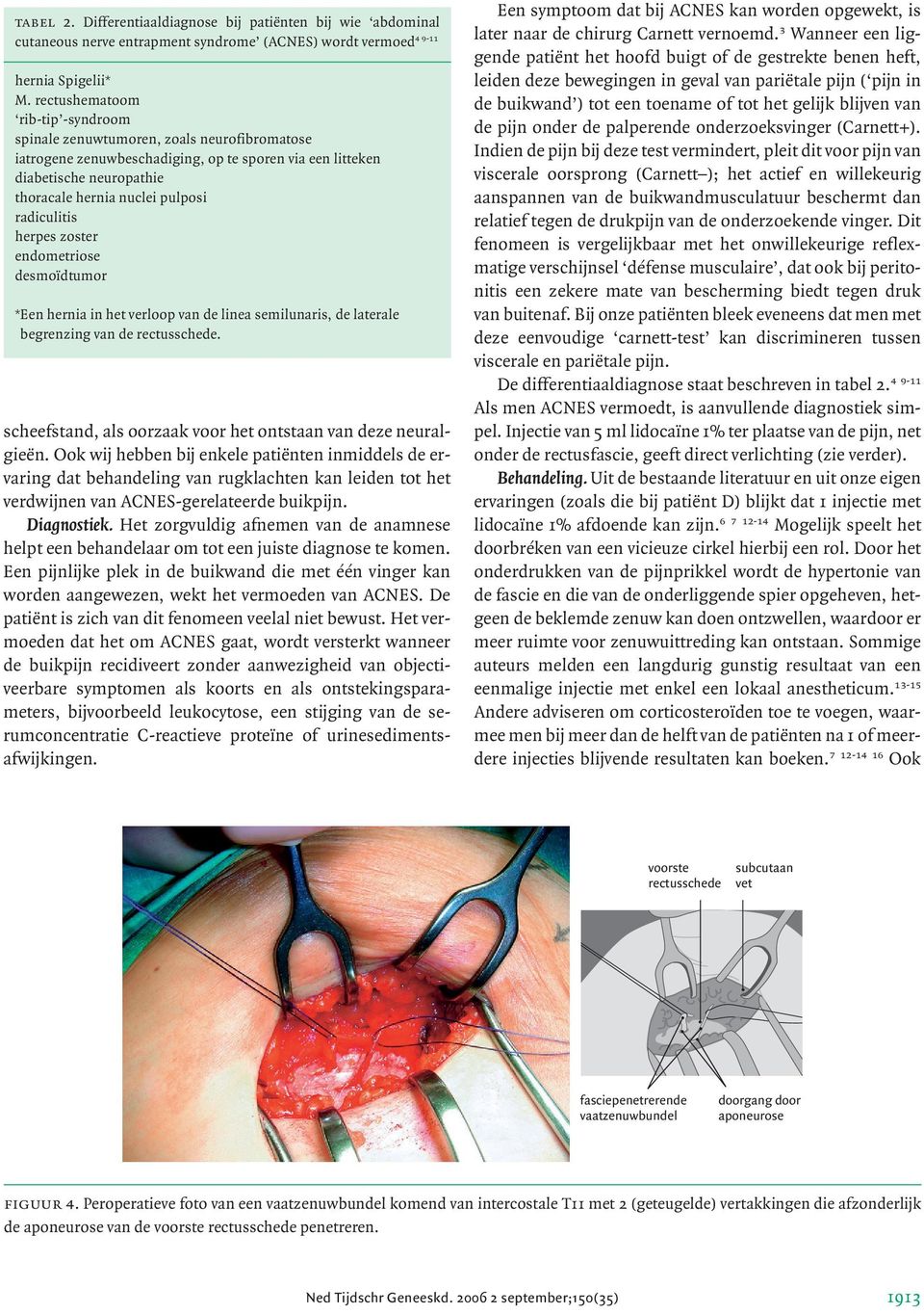 radiculitis herpes zoster endometriose desmoïdtumor * Een hernia in het verloop van de linea semilunaris, de laterale begrenzing van de rectusschede.