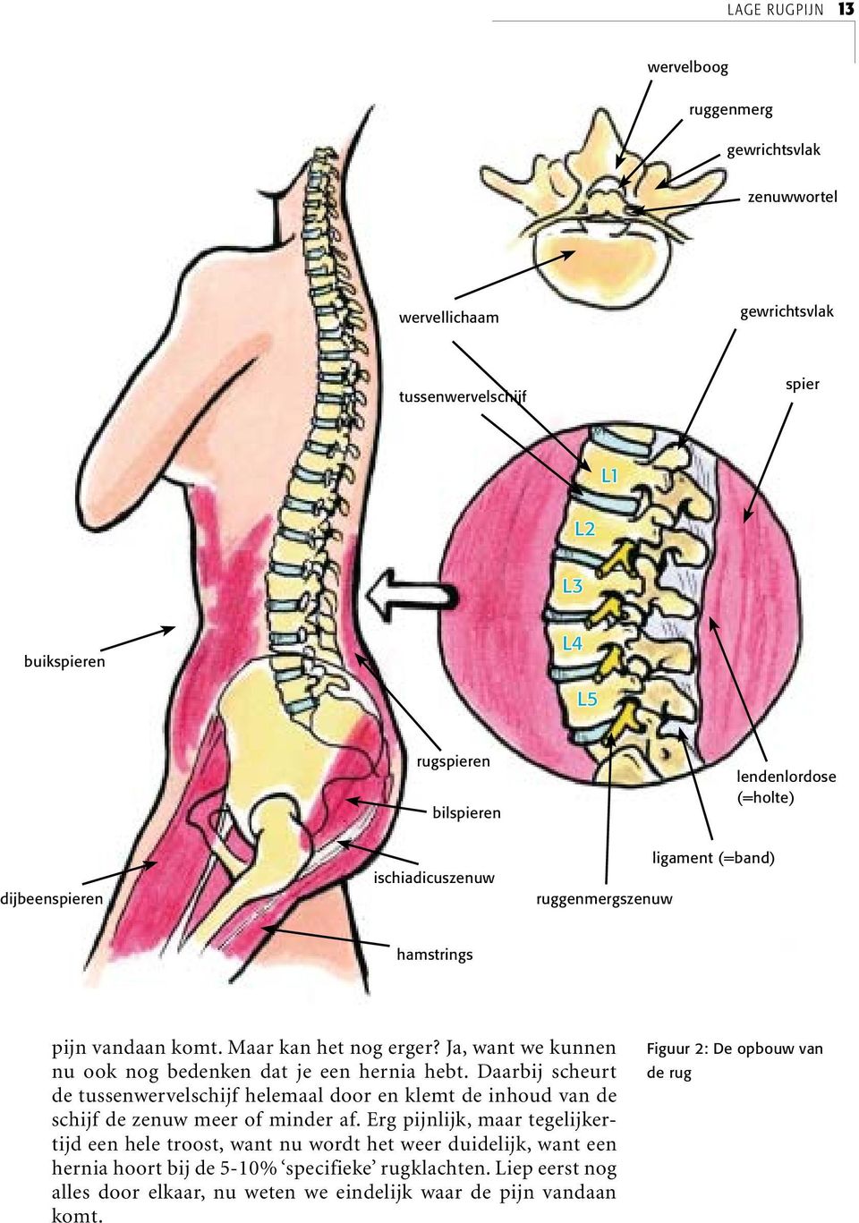 Ja, want we kunnen nu ook nog bedenken dat je een hernia hebt. Daarbij scheurt de tussenwervelschijf helemaal door en klemt de inhoud van de schijf de zenuw meer of minder af.