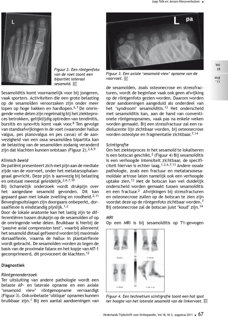 6,7 De omringende weke delen zijn regelmatig bij het ziekteproces betrokken, gelijktijdig optreden van tendinitis, bursitis en synovitis komt vaak voor.