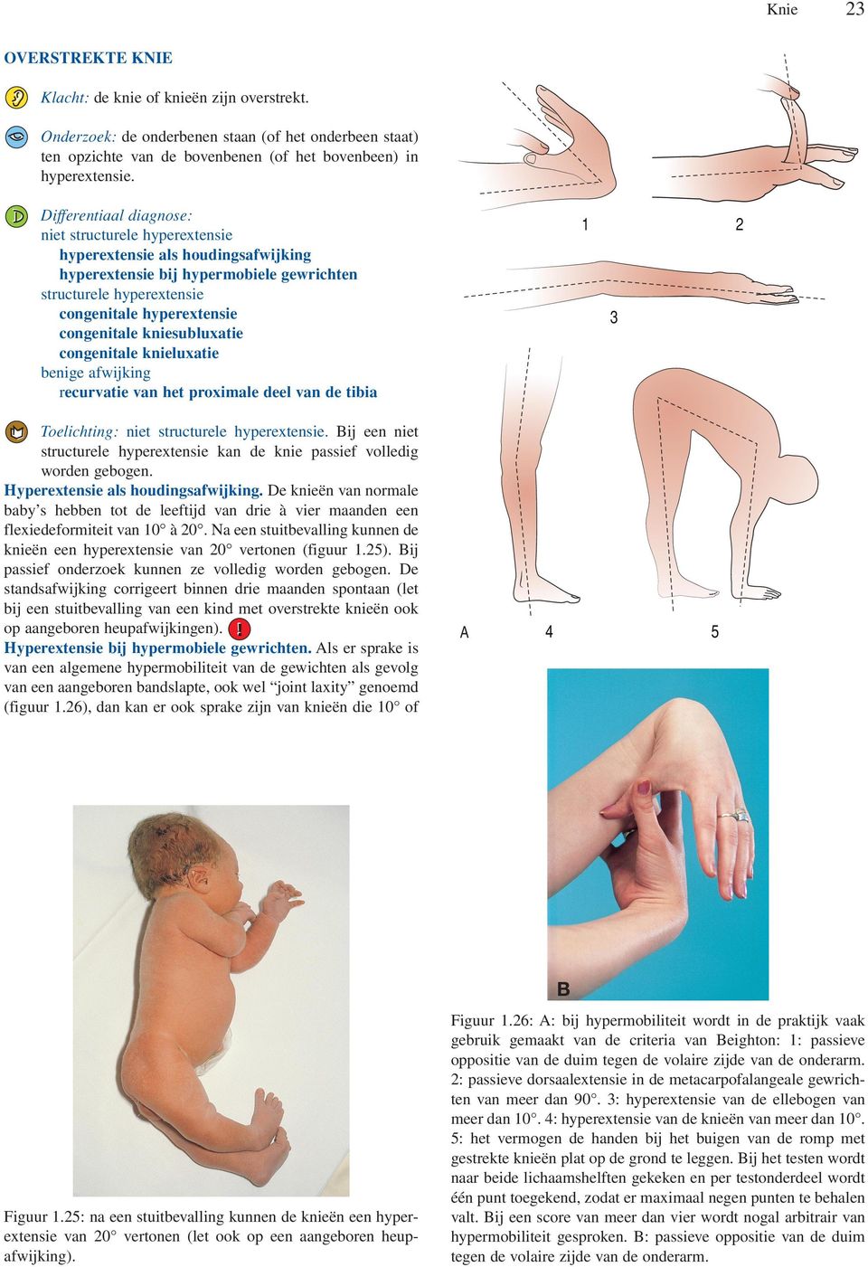 kniesubluxatie congenitale knieluxatie benige afwijking recurvatie van het proximale deel van de tibia Toelichting: niet structurele hyperextensie.