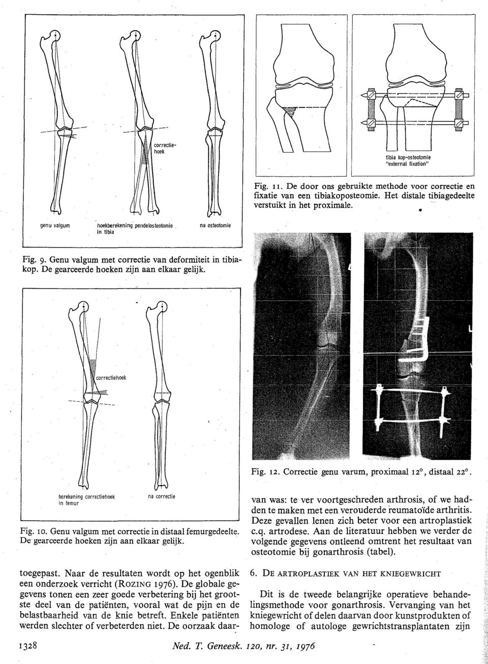 Correctie genu varum, proximaal 12, distaal 22. berekening correctiehoek!n femur na correctie Fig. 10. Genu valgum met correctie in distaal femurgedeelte. De gearceerde hoeken zijn aan elkaar gelijk.