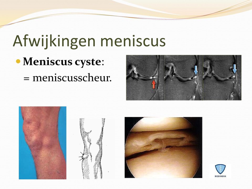 Meniscus