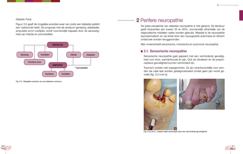 Genezing Chronisch ulcus * Overlijden Overleven VOETULCUS amputatie * Overlijden Infectie * Comorbiditeit Gangreen 2 Perifere neuropathie De juiste prevalentie van diabetes neuropathie is niet gekend.