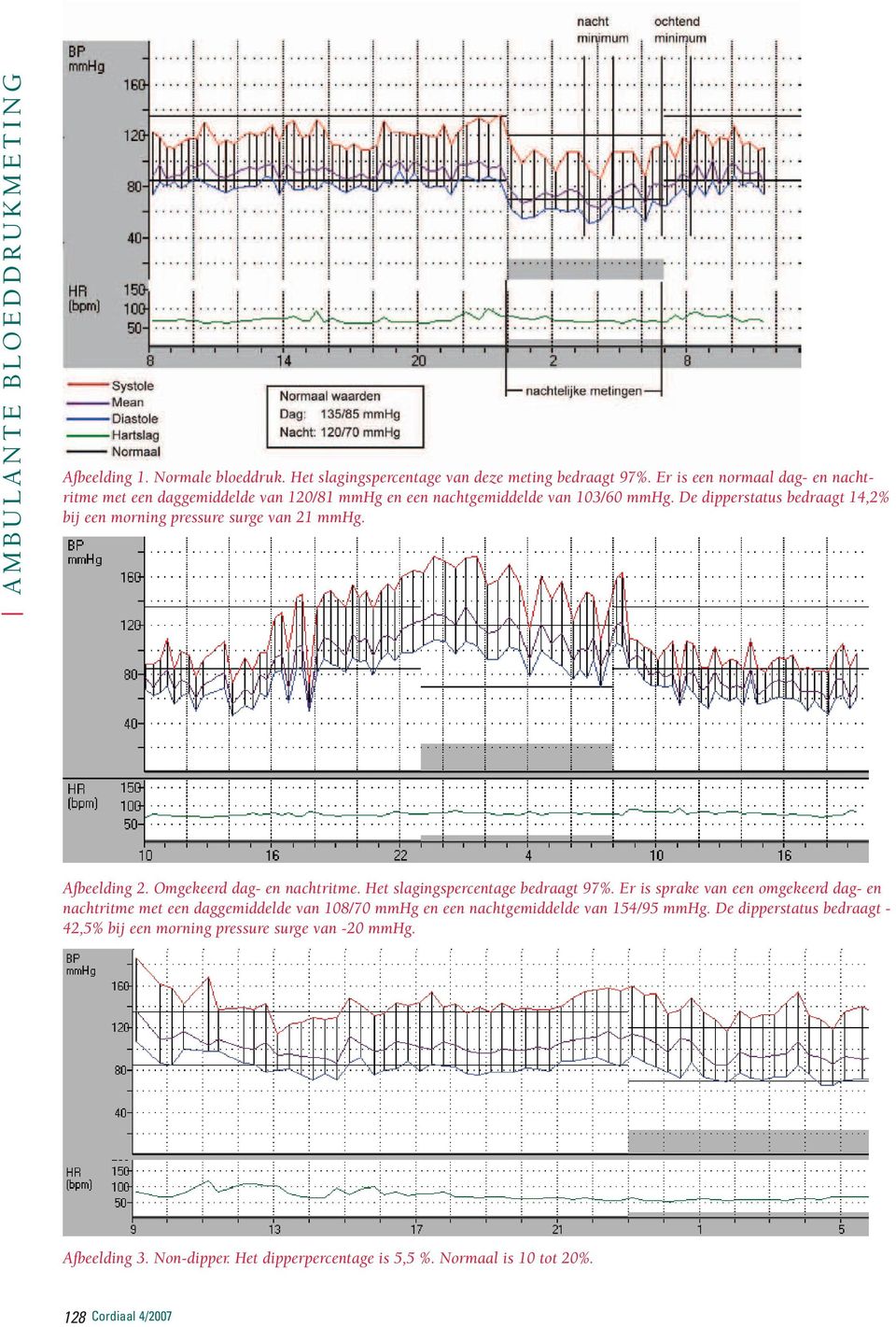 De dipperstatus bedraagt 14,2% bij een morning pressure surge van 21 mmhg. Afbeelding 2. Omgekeerd dag- en nachtritme. Het slagingspercentage bedraagt 97%.