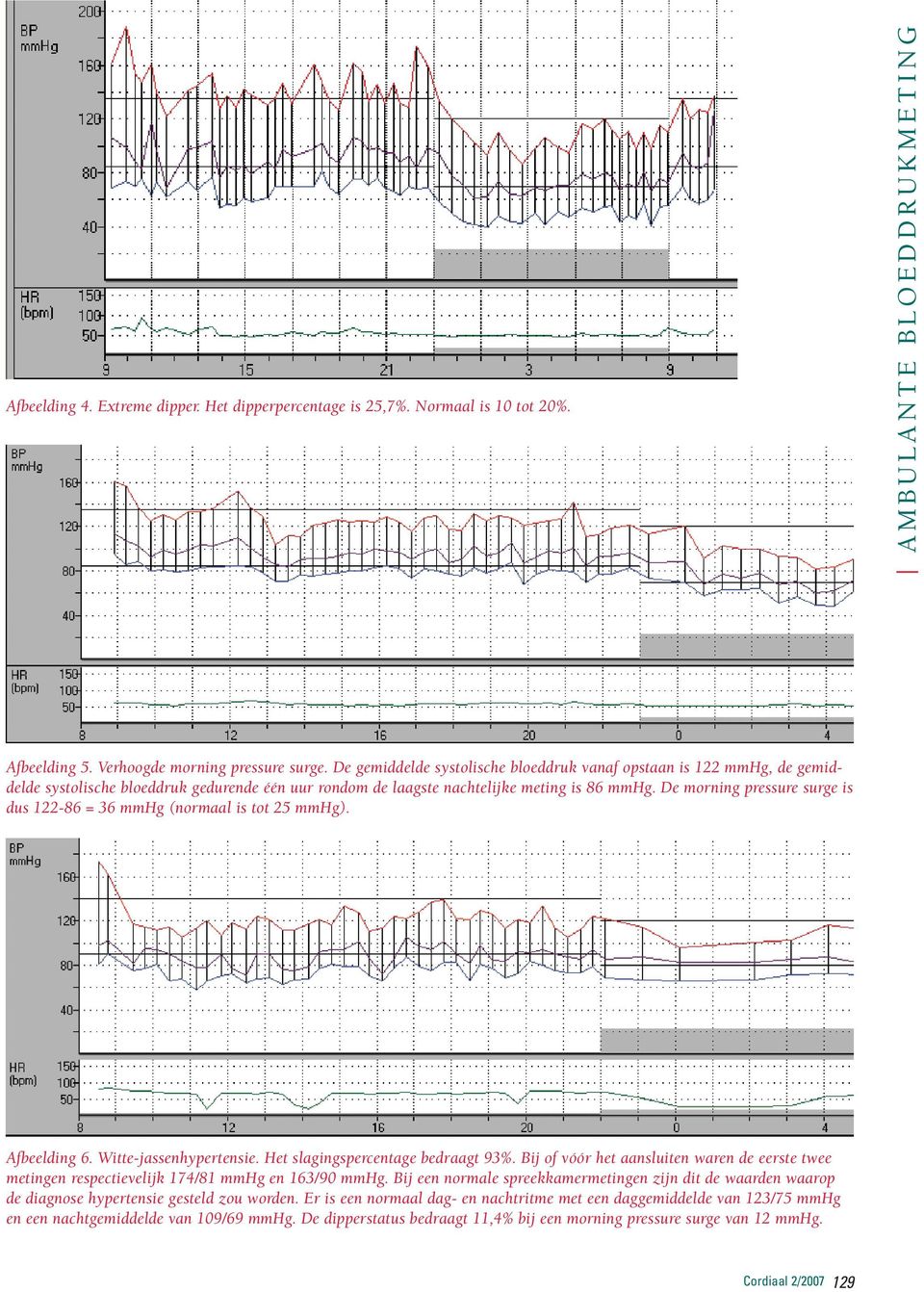 De morning pressure surge is dus 122-86 = 36 mmhg (normaal is tot 25 mmhg). Afbeelding 6. Witte-jassenhypertensie. Het slagingspercentage bedraagt 93%.