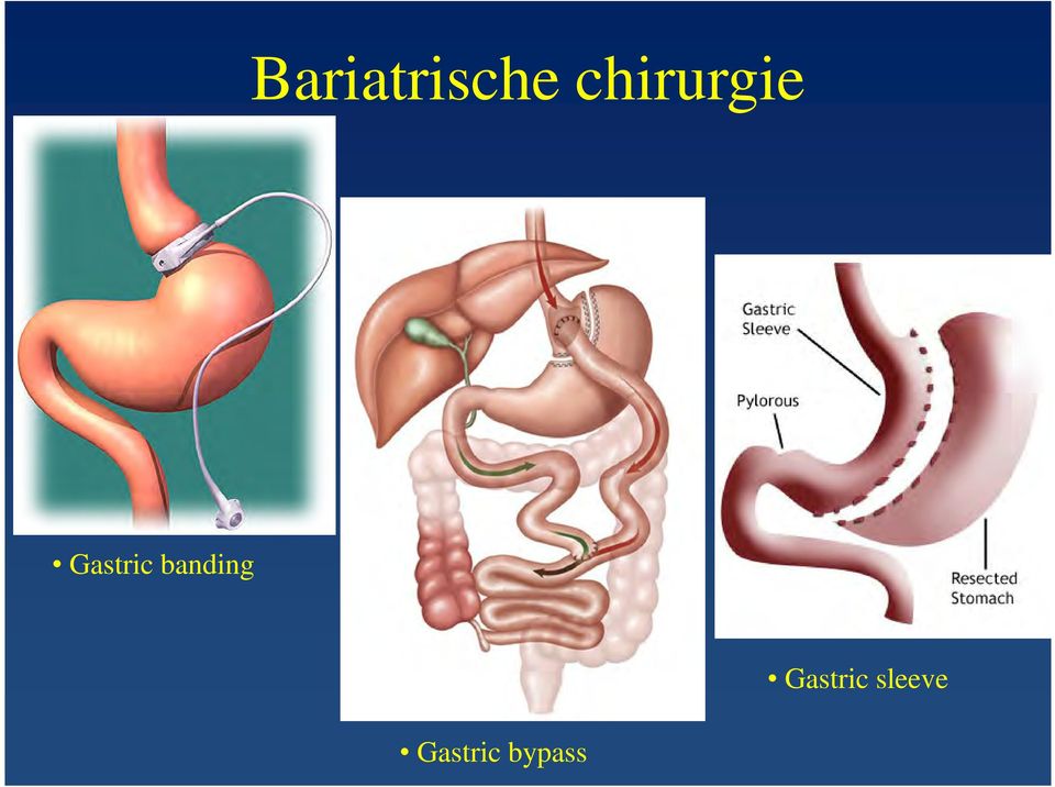 Gastric banding