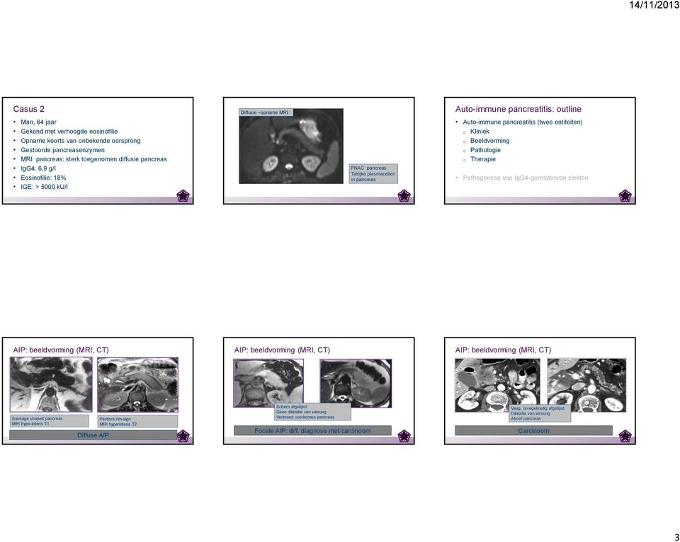 Pathologie o Therapie Pathogenese van IgG4-gerelateerde ziekten AIP: beeldvorming (MRI, CT) AIP: beeldvorming (MRI, CT) AIP: beeldvorming (MRI, CT) Sausage shaped pancreas MRI hypo-intens T1 Diffuse
