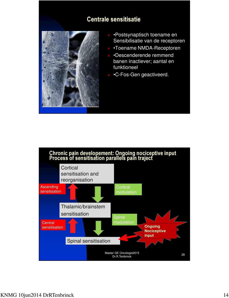 Chronic pain developement: Ongoing nociceptive input Process of sensitisation parallels pain traject Cortical sensitisation and